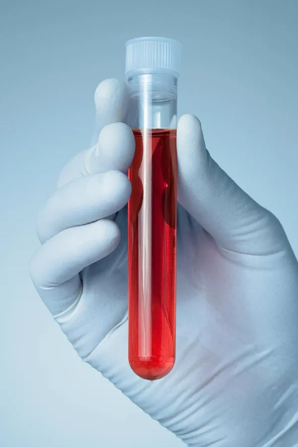 A close-up of a doctor's gloved hand holding a vial a plasma, signifying autoimmune disease treatment from Allen Green, M.D. of Center for Optimum Health in Los Angeles.