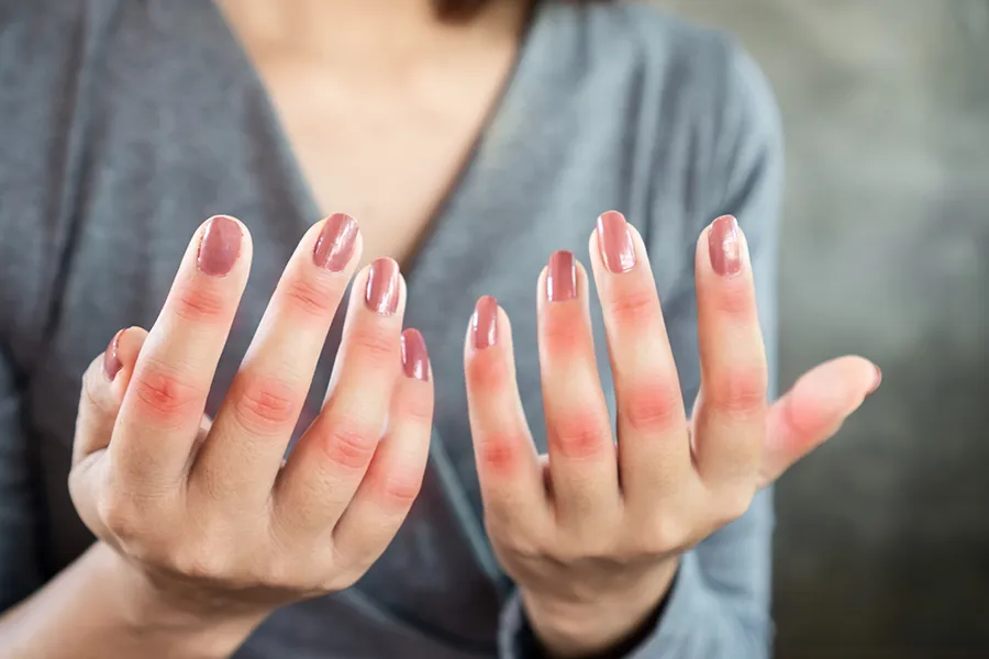 Close-up of the hands of a woman in a gray shirt, with swollen, red knuckles. Get treatment for Lupus from Allen Green, M.D. of Center for Optimum Health in Los Angeles.