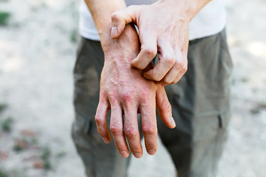 Close-up of a man scratching his hands while experiencing Psoriasis. Get care for Psoriasis from Allen Green, M.D. of Center for Optimum Health in Los Angeles.
