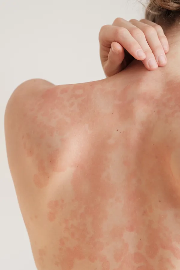 The back and shoulder of a woman experiencing Psoriasis. Get treatment for Psoriasis from Allen Green, M.D. of Center for Optimum Health in Los Angeles.