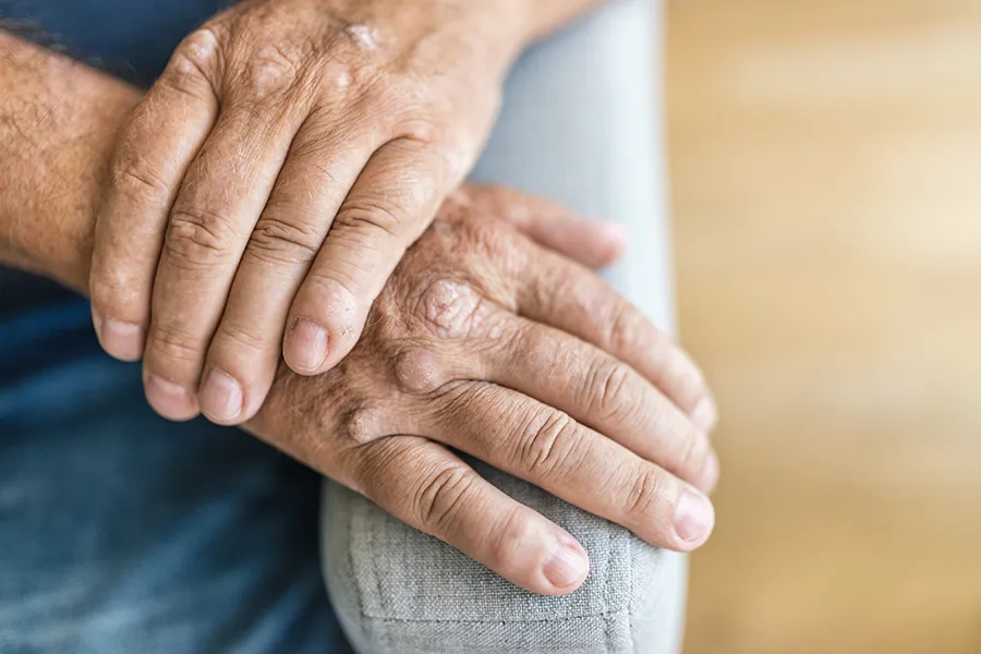 Psoriatic-Arthritis-Clinic Close-up of a mature mans hands showing signs of psoriatic arthritis. Get treatment for psoriatic arthritis from Allen Green, M.D. of Center for Optimum Health in Los Angeles.