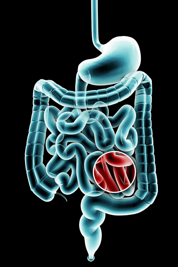 3D illustration of the digestive system in blue tones, with an area of discomfort in red tones. Get treatment for Ulcerative Colitis from Allen Green, M.D. of Center for Optimum Health in Los Angeles.